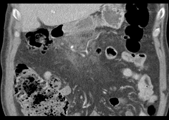 File:Acute pancreatitis and walled-off necrosis (Radiopaedia 29888-30403 Coronal C+ portal venous phase 20).jpg