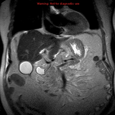 File:Acute pancreatitis with incidental pancreatic lipoma (Radiopaedia 10190-10732 Coronal T2 12).jpg