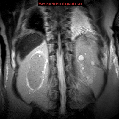 File:Acute pancreatitis with incidental pancreatic lipoma (Radiopaedia 10190-10732 Coronal T2 27).jpg