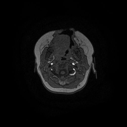 Acute phase of hemiconvulsion-hemiplegia epilepsy syndrome (Radiopaedia 29309-29745 Axial TOF angiography 167).jpg