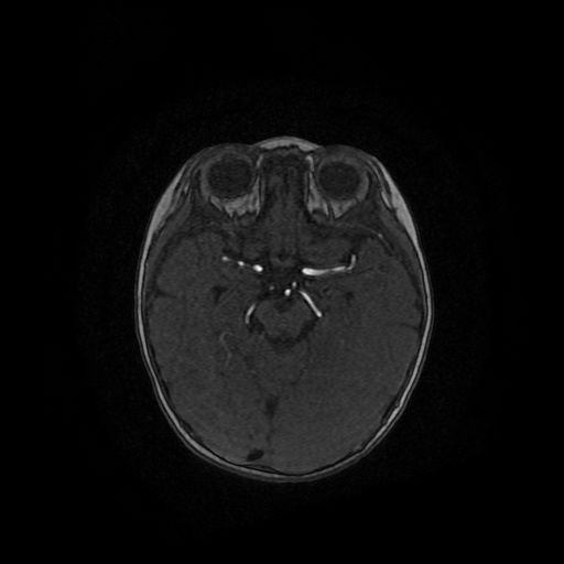 File:Acute phase of hemiconvulsion-hemiplegia epilepsy syndrome (Radiopaedia 29309-29745 Axial TOF angiography 82).jpg