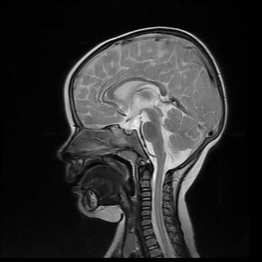 File:Acute phase of hemiconvulsion-hemiplegia epilepsy syndrome (Radiopaedia 29309-29745 Sagittal T2 11).jpg