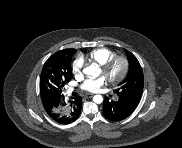 Acute pulmonary embolism with pulmonary infarcts (Radiopaedia 77688-89908 Axial C+ CTPA 33).jpg