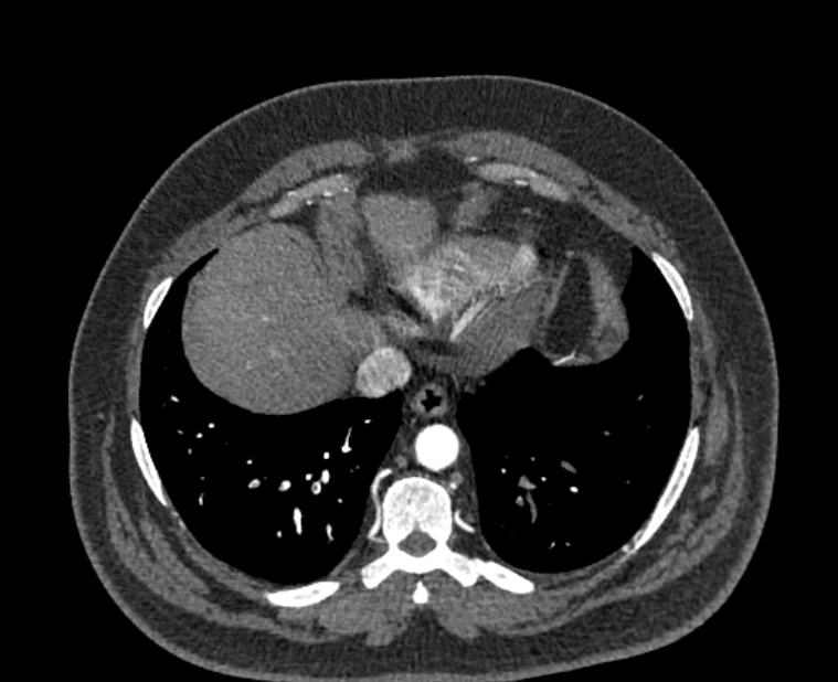 Acute pulmonary embolism with pulmonary infarcts (Radiopaedia 77688-89908 Axial C+ CTPA 52).jpg