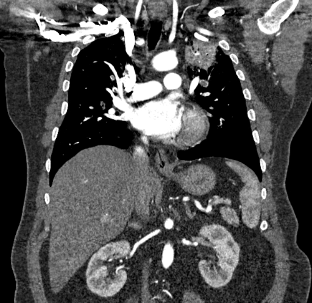 Acute pulmonary embolism with pulmonary infarcts (Radiopaedia 77688-89908 Coronal C+ CTPA 47).jpg