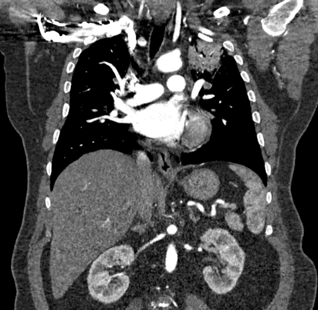 Acute pulmonary embolism with pulmonary infarcts (Radiopaedia 77688-89908 Coronal C+ CTPA 48).jpg