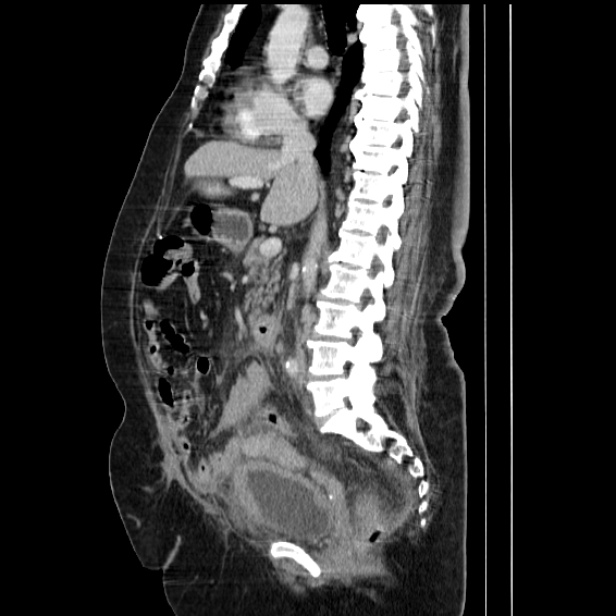 Acute pyelonephritis (Radiopaedia 25657-25837 Sagittal renal parenchymal phase 40).jpg
