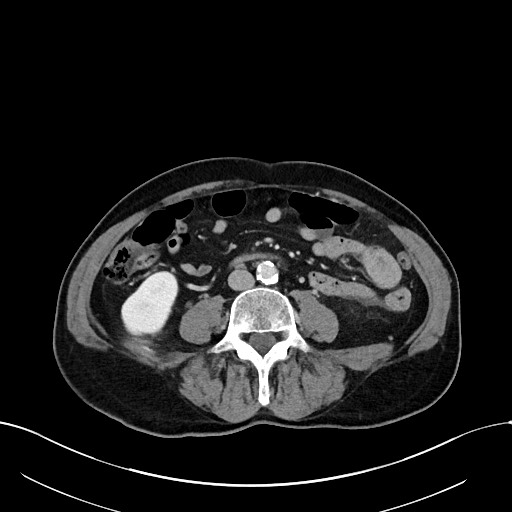 Acute renal infarction (Radiopaedia 59375-66736 Axial C+ portal venous phase 60).jpg