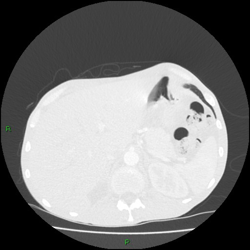 Acute right lung abscess (Radiopaedia 34806-36258 Axial lung window 184).jpg
