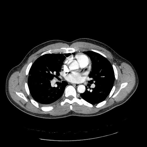 Acute segmental pulmonary emboli and pulmonary infarction (Radiopaedia 62264-70444 Axial C+ CTPA 59).jpg