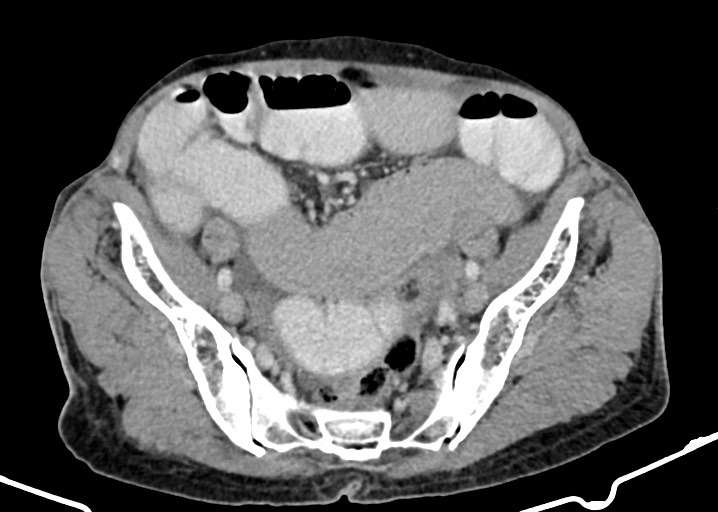 Acute small bowel (ileal) volvulus (Radiopaedia 71740-82139 Axial C+ portal venous phase 157).jpg