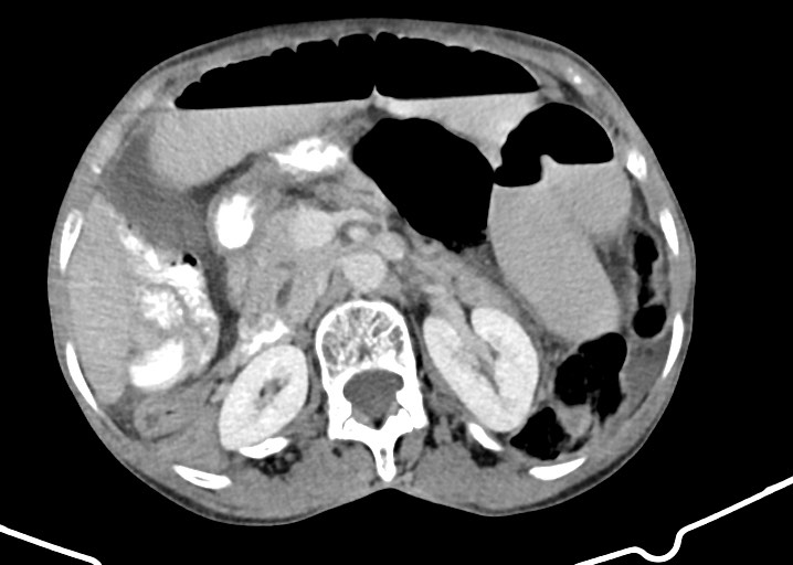 Acute small bowel (ileal) volvulus (Radiopaedia 71740-82139 Axial C+ portal venous phase 81).jpg