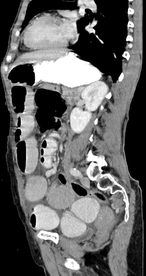 Acute small bowel (ileal) volvulus (Radiopaedia 71740-82139 Sagittal C+ portal venous phase 70).jpg