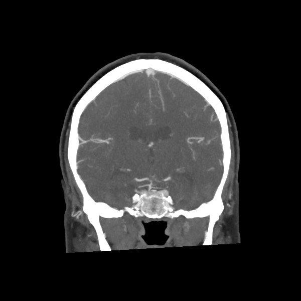 Acute subarachnoid hemorrhage and accessory anterior cerebral artery (Radiopaedia 69231-79009 Coronal C+ arterial phase 44).jpg