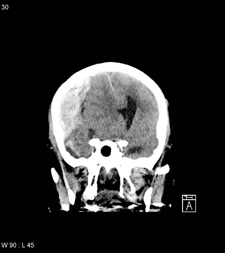 Acute subdural hematoma with myelofibrosis (Radiopaedia 52582-58494 Coronal non-contrast 21).jpg