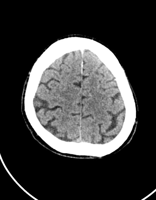 Acute superior cerebellar artery territory infarct (Radiopaedia 84104-99359 Axial non-contrast 18).jpg