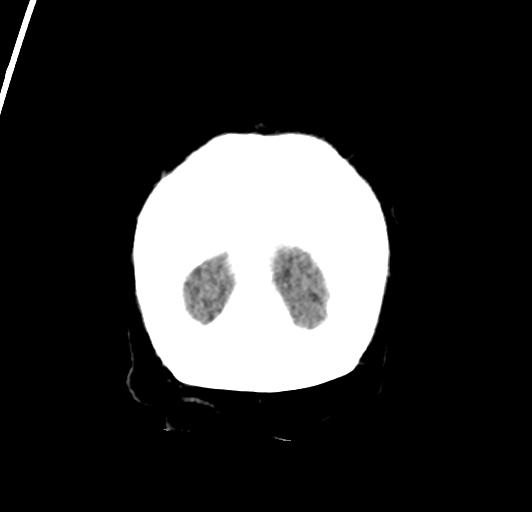 File:Acute traumatic subdural hematoma (Radiopaedia 82921-97257 Coronal non-contrast 78).jpg