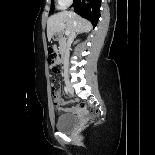 Acute uncomplicated appendicitis (Radiopaedia 73704-84499 Sagittal C+ portal venous phase 101).jpg