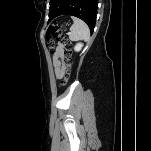 Acute uncomplicated appendicitis (Radiopaedia 73704-84499 Sagittal C+ portal venous phase 159).jpg