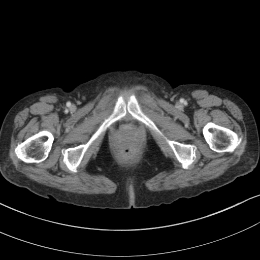 Adenocarcinoma of cecum (Radiopaedia 59222-66549 Axial C+ portal venous phase 165).jpg
