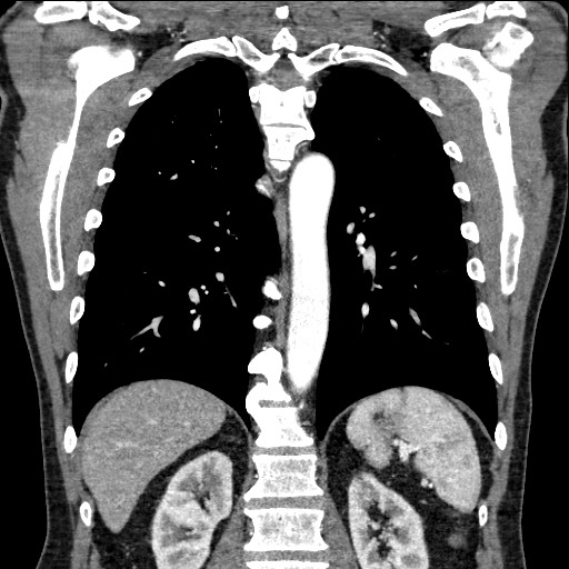 Adenocarcinoma of the lung (Radiopaedia 59871-67325 Coronal C+ arterial phase 48).jpg