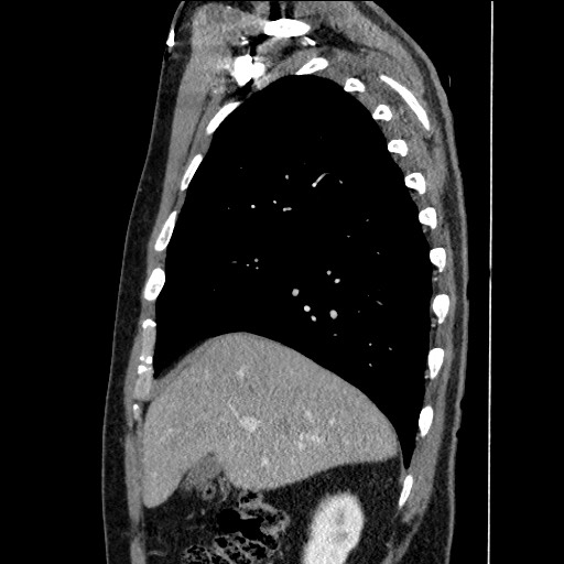 Adenocarcinoma of the lung (Radiopaedia 59871-67325 Sagittal C+ arterial phase 23).jpg