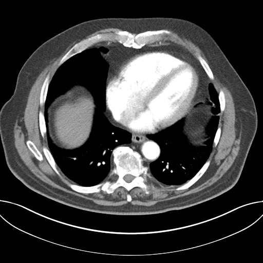 File:Adenocarcioma of rectum- T1 lesion (Radiopaedia 36921-38547 Axial C+ arterial phase 39).png