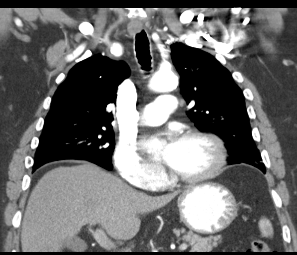 Adenocarcioma of rectum- T1 lesion (Radiopaedia 36921-38547 Coronal C+ arterial phase 30).png