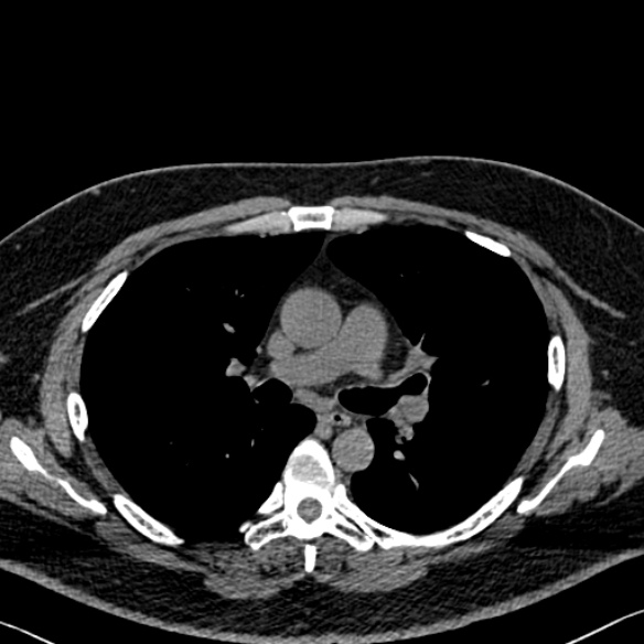 Adenoid cystic carcinoma of the trachea (Radiopaedia 49042-54137 Axial non-contrast 149).jpg