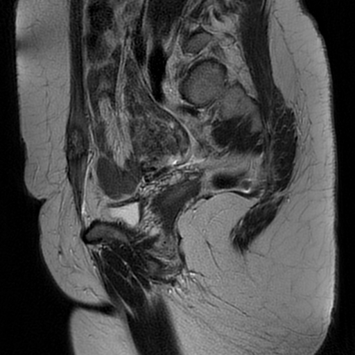 File:Adenomyosis-scar endometriosis (Radiopaedia 65863-75022 Sagittal T2 8).jpg
