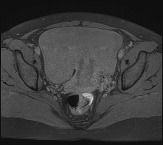 File:Adenomyosis - ovarian endometriomas (Radiopaedia 67031-76350 Axial T1 fat sat 17).jpg