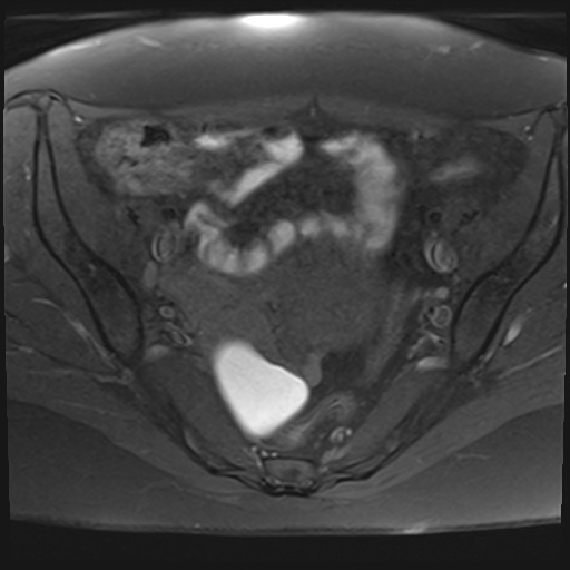 File:Adenomyosis and endometriotic cysts (Radiopaedia 82300-96367 Axial T1 fat sat 19).jpg