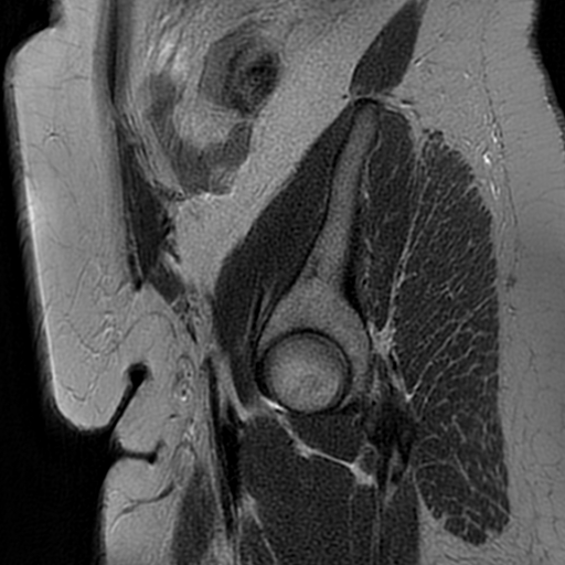 File:Adenomyosis within a didelphys uterus (Radiopaedia 70175-80215 Sagittal T2 1).jpg