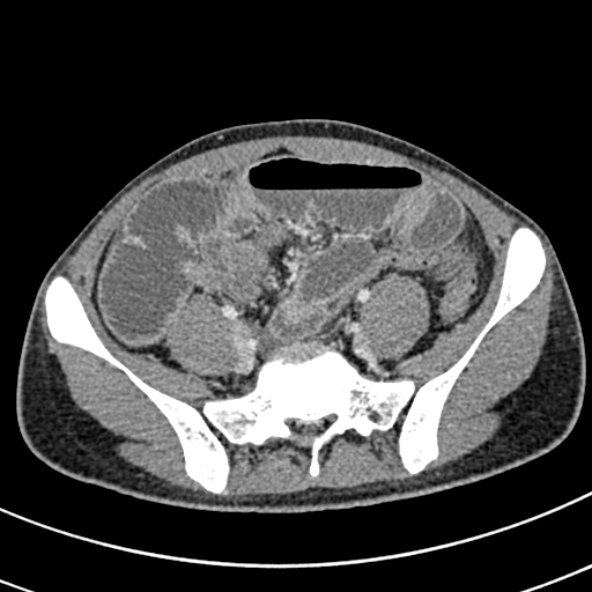 Adhesional small bowel obstruction (Radiopaedia 52107-57980 Axial C+ portal venous phase 92).jpg
