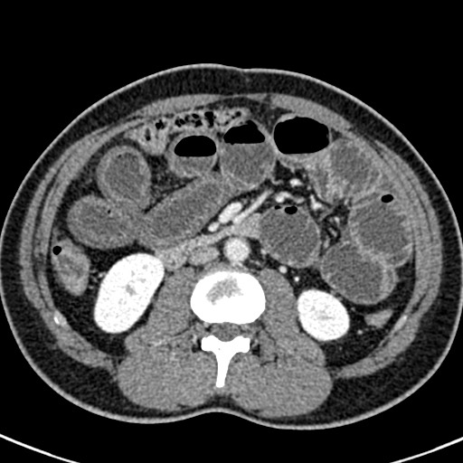 Adhesional small bowel obstruction (Radiopaedia 58900-66131 Axial C+ portal venous phase 24).jpg