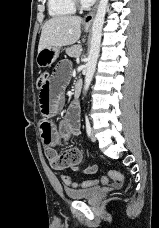 Adhesional small bowel obstruction (Radiopaedia 58900-66131 Sagittal C+ portal venous phase 138).jpg