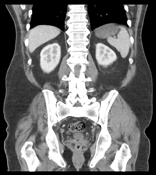 Adhesions within abdominal wall hernia (Radiopaedia 58283-65394 Coronal C+ portal venous phase 51).png