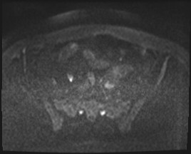 Adnexal multilocular cyst (O-RADS US 3- O-RADS MRI 3) (Radiopaedia 87426-103754 Axial DWI 65).jpg