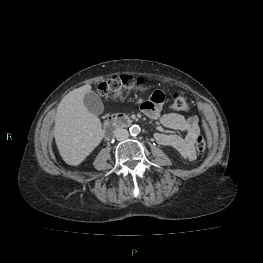 File:Adrenal collision tumor (ACT) (Radiopaedia 48462-53379 Axial C+ delayed 35).jpg