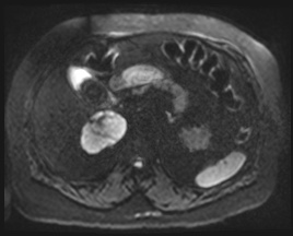 Adrenal cortical carcinoma (Radiopaedia 64017-72770 Axial DWI 58).jpg