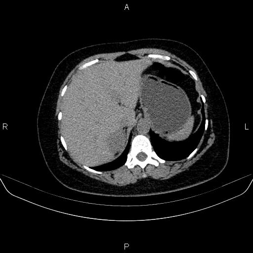 File:Adrenal cortical carcinoma (Radiopaedia 84882-100379 Axial non-contrast 17).jpg