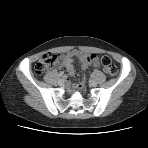 File:Adrenal cyst (Radiopaedia 64869-73813 Axial C+ portal venous phase 58).jpg