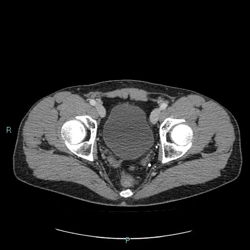 File:Adrenal cystic lymphangioma (Radiopaedia 83161-97534 Axial C+ portal venous phase 91).jpg