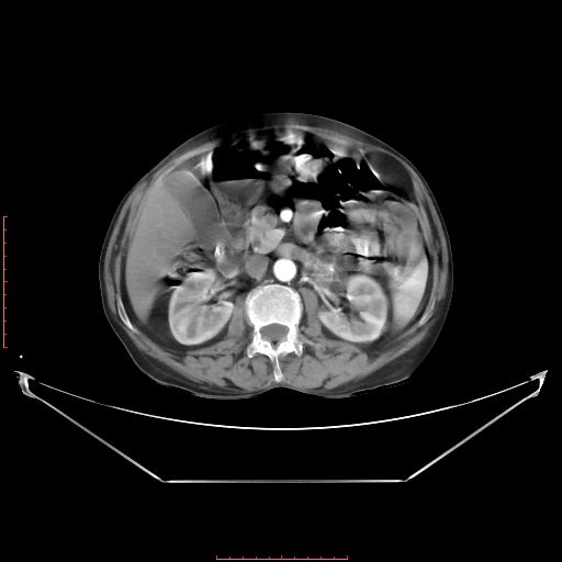 Adrenal hemangioma (Radiopaedia 68923-78668 Axial C+ arterial phase 34).jpg