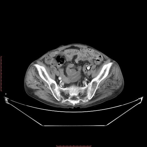 Adrenal hemangioma (Radiopaedia 68923-78668 Axial C+ portal venous phase 57).jpg