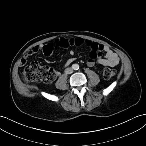 File:Adrenal lymphoma (Radiopaedia 73730-84529 Axial C+ portal venous phase 74).jpg