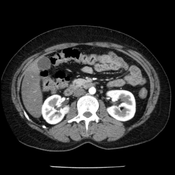 Adrenal myelolipoma (Radiopaedia 43401-46759 Axial C+ arterial phase 45).jpg