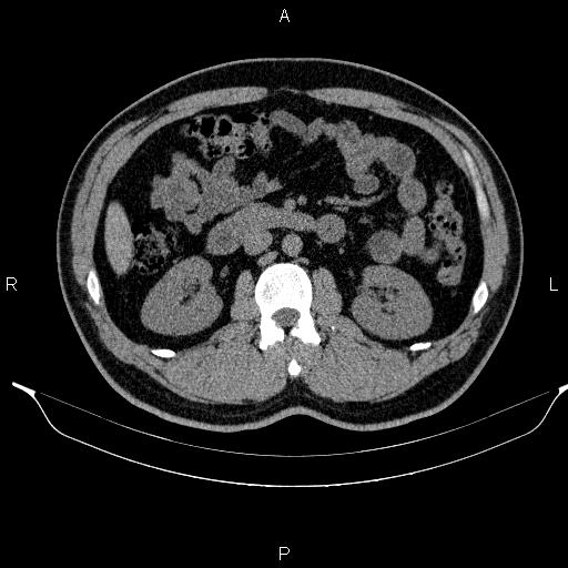 Adrenal myelolipoma (Radiopaedia 84321-99619 Axial non-contrast 50).jpg