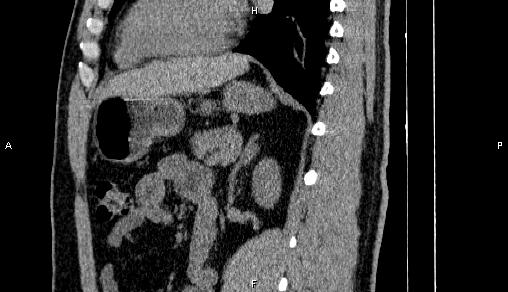 File:Adrenal myelolipoma (Radiopaedia 84321-99619 Sagittal non-contrast 68).jpg