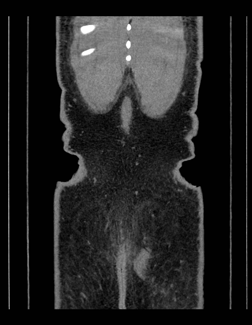 Adrenal myelolipoma - bilateral (Radiopaedia 74805-85810 Coronal C+ portal venous phase 41).jpg